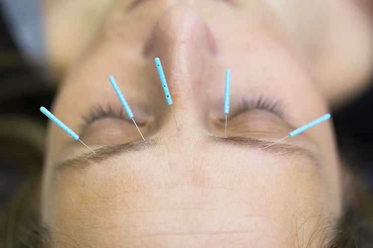 Nycitywoman Facial Acupuncture For Skin Rejuvenation Nycitywoman